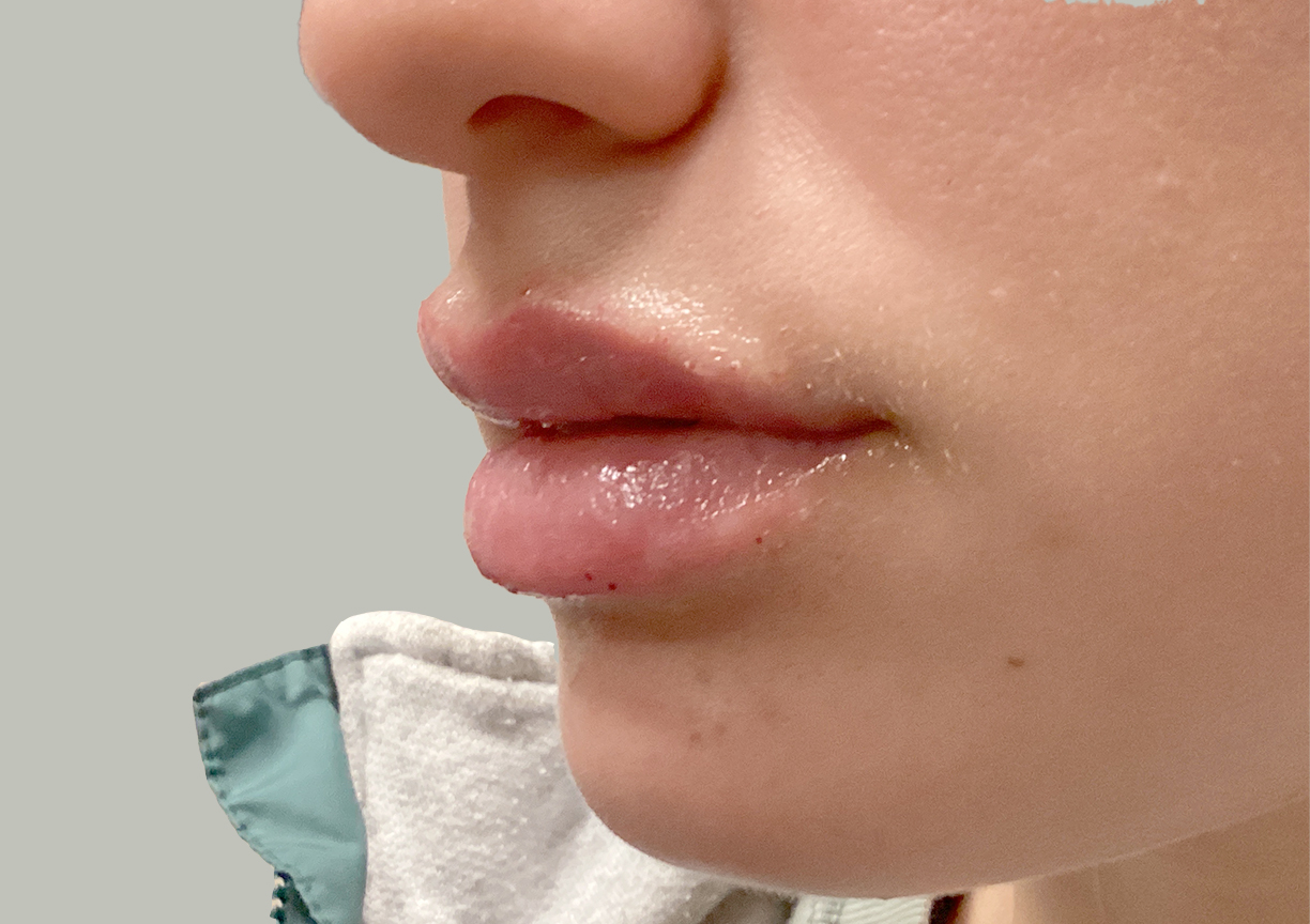 Injectables And Fillers 05