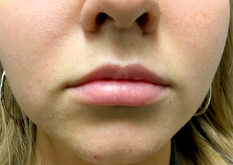 Injectables And Fillers 01