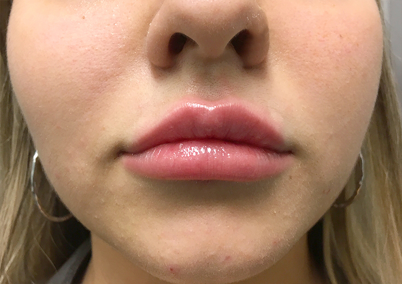 Injectables And Fillers 110