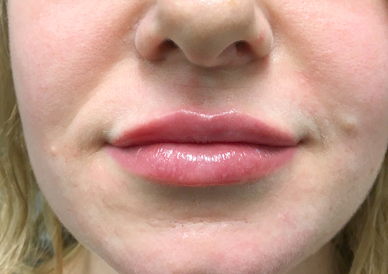 Injectables And Fillers 111