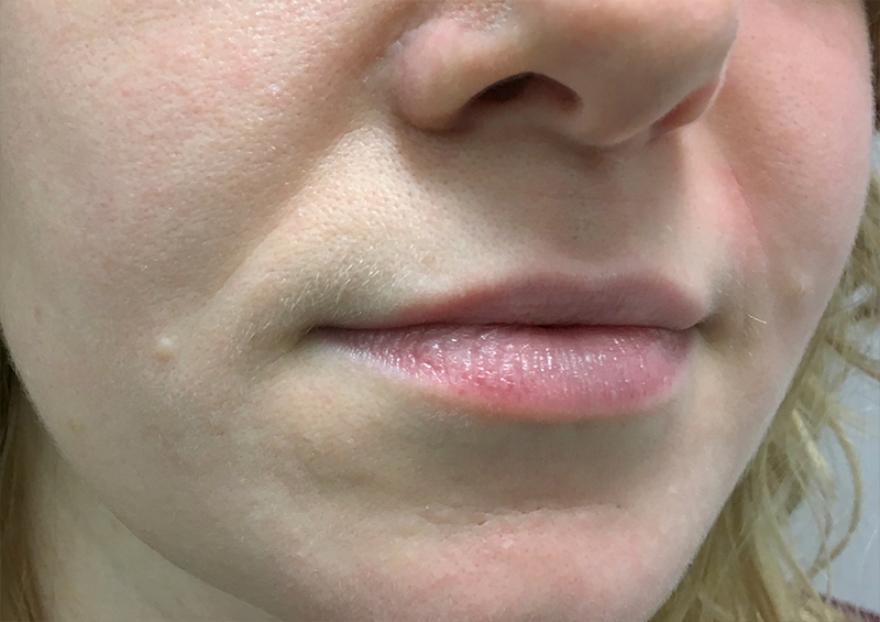 Injectables And Fillers 03