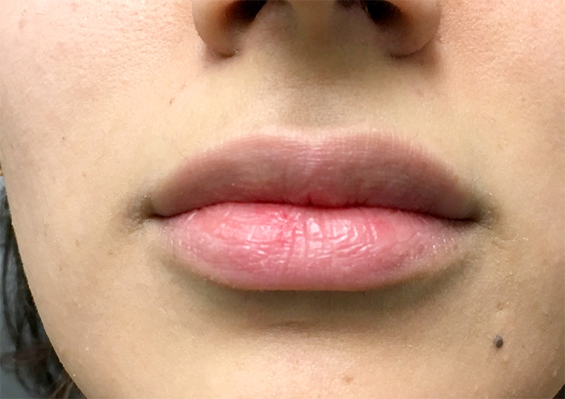 Injectables And Fillers 01