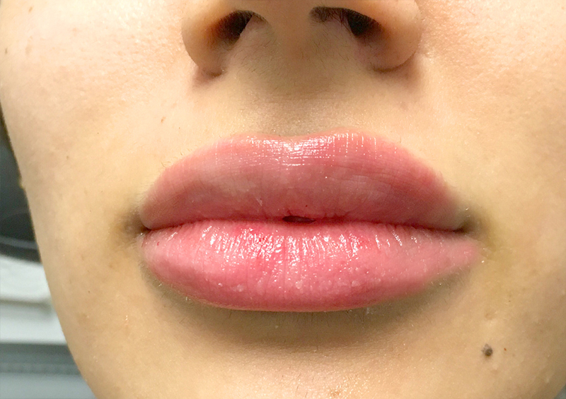 Injectables And Fillers 112