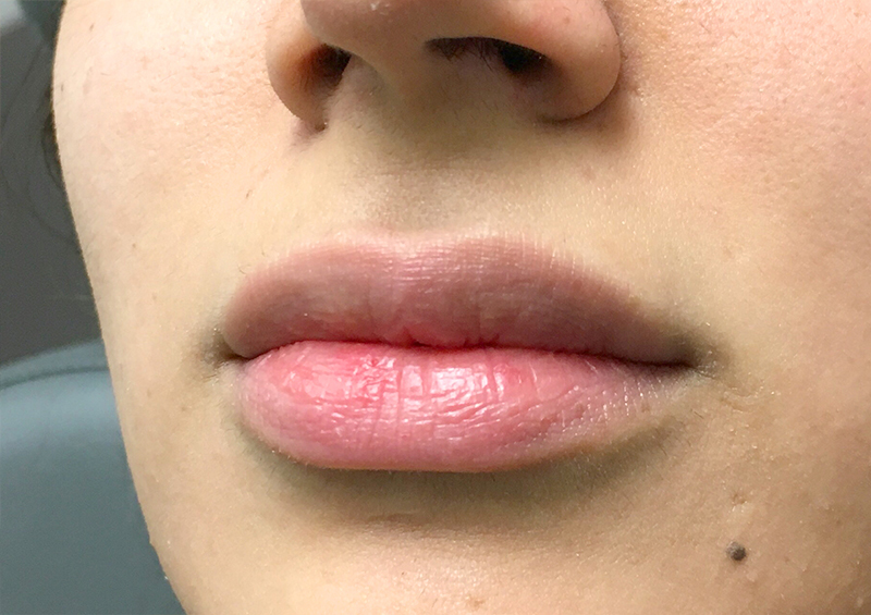 Injectables And Fillers 03