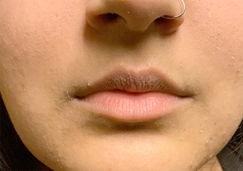 Injectables And Fillers 01