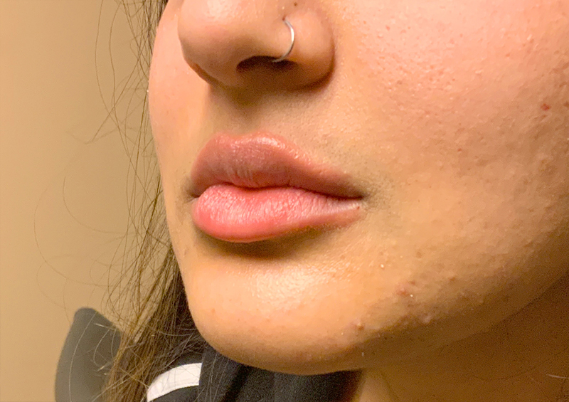 Injectables And Fillers 03