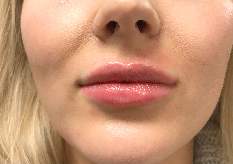 Injectables And Fillers 114