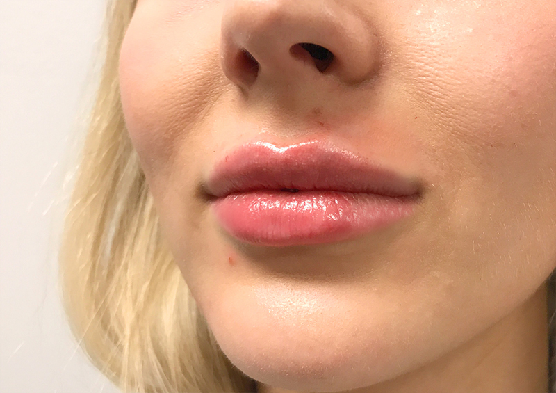 Injectables And Fillers 03