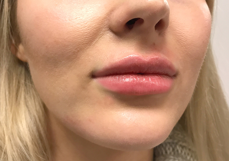 Injectables And Fillers 05