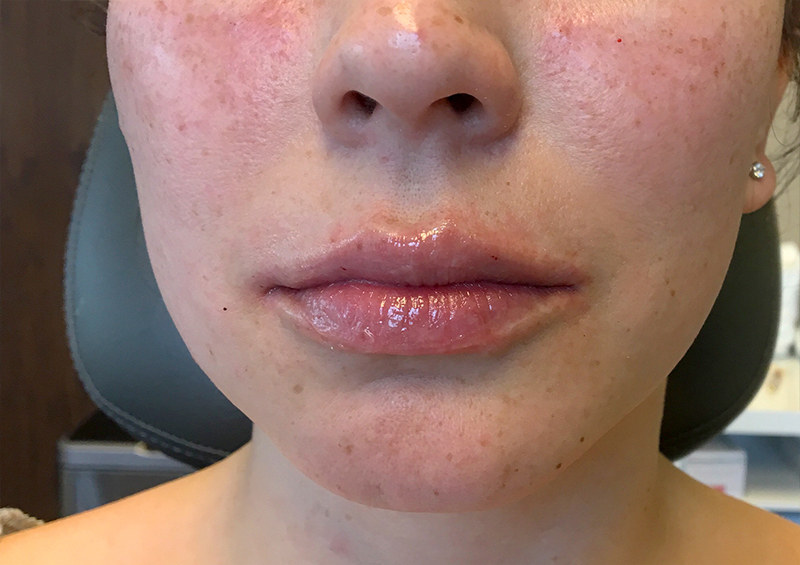 Injectables And Fillers 115