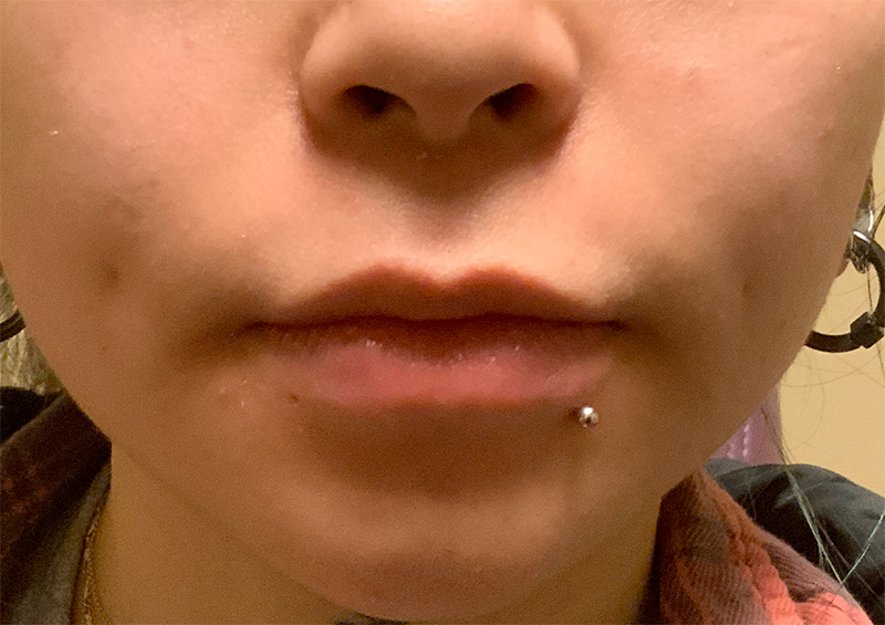 Injectables And Fillers 01