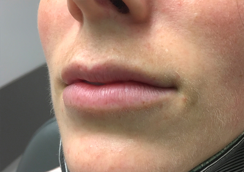 Injectables And Fillers 03