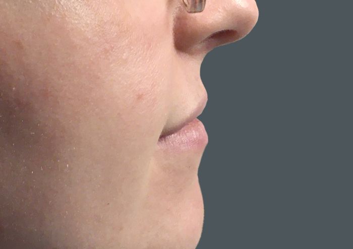 Injectables And Fillers 01