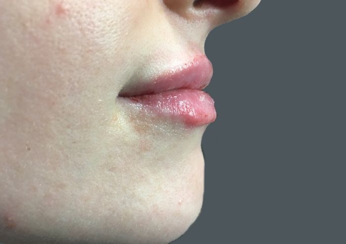 Injectables And Fillers 12