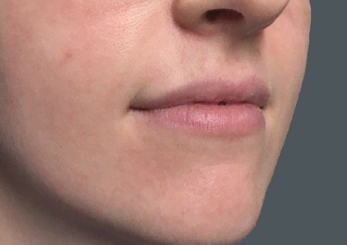 Injectables And Fillers 03