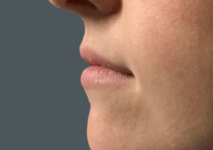 Injectables And Fillers 05