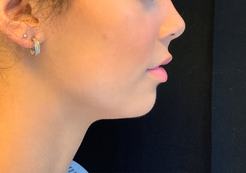 Injectables And Fillers 03