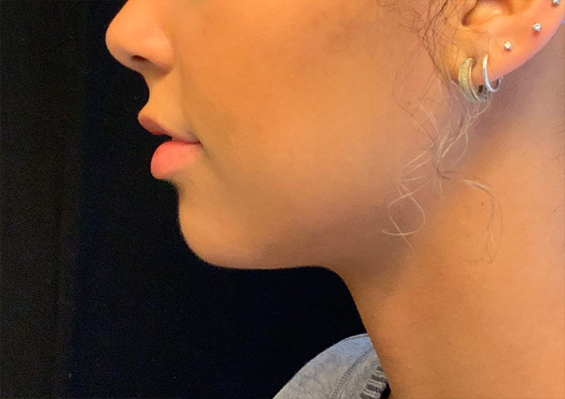 Injectables And Fillers 05