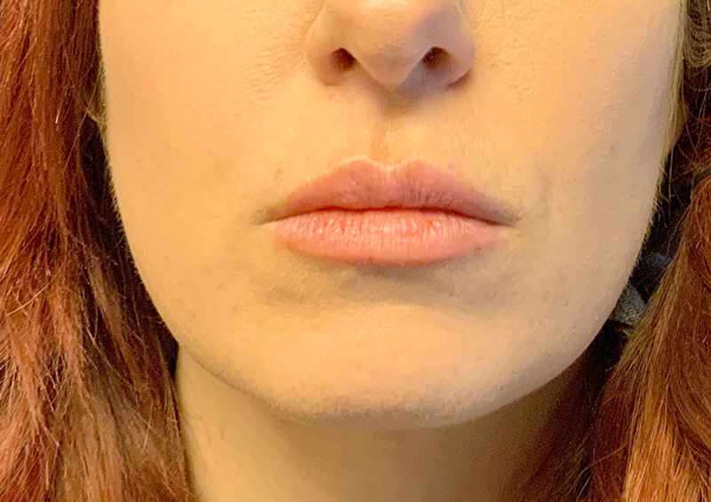 Injectables And Fillers 01