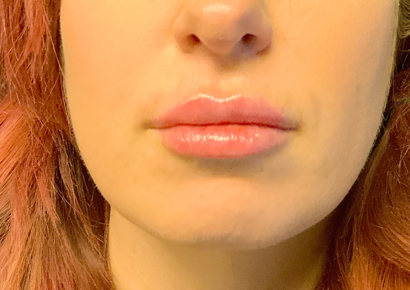 Injectables And Fillers 121