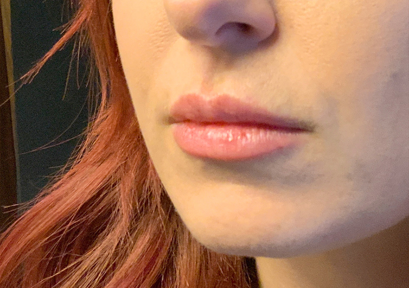 Injectables And Fillers 03