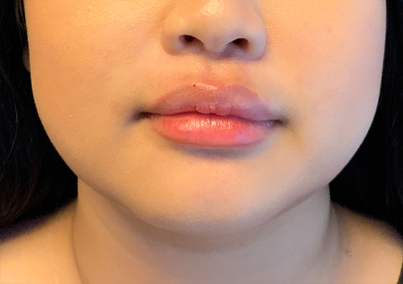 Injectables And Fillers 122