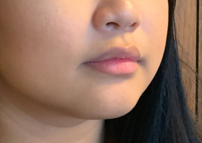 Injectables And Fillers 03