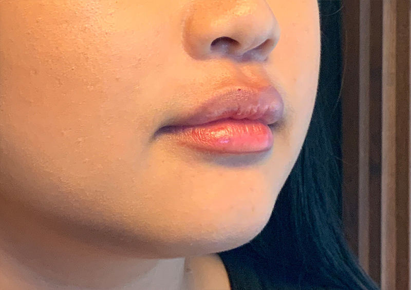 Injectables And Fillers 03