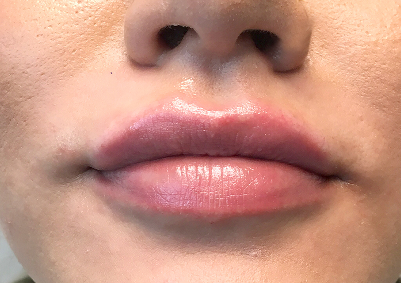 Injectables And Fillers 123