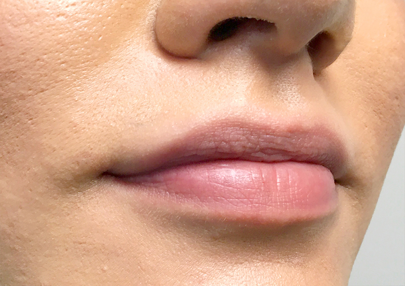 Injectables And Fillers 03