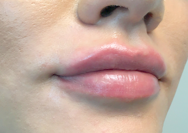 Injectables And Fillers 03