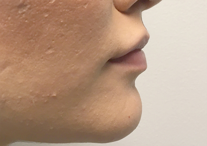 Injectables And Fillers 05