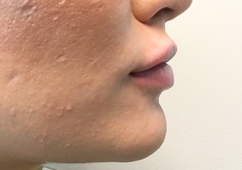 Injectables And Fillers 05