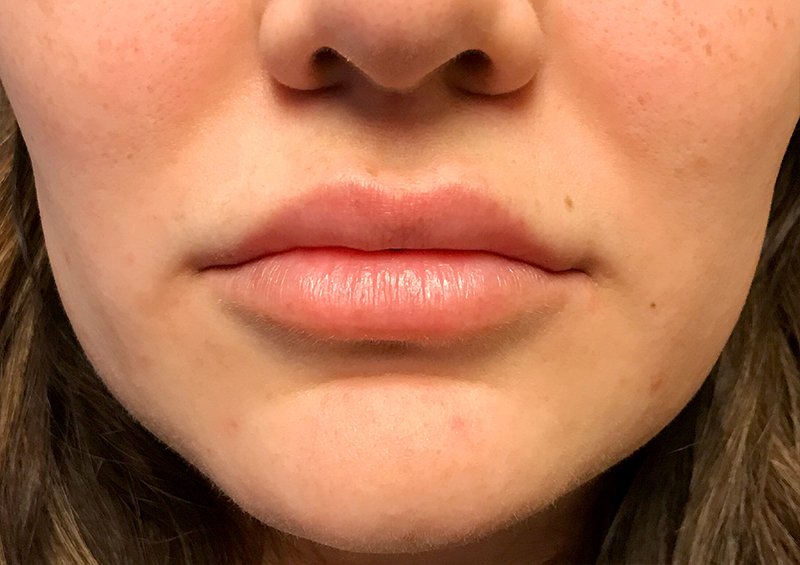 Injectables And Fillers 124