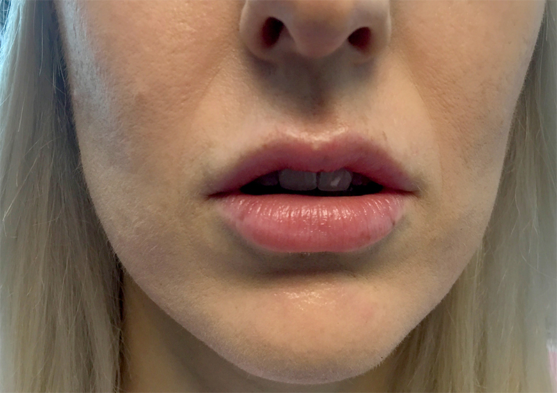 Injectables And Fillers 01