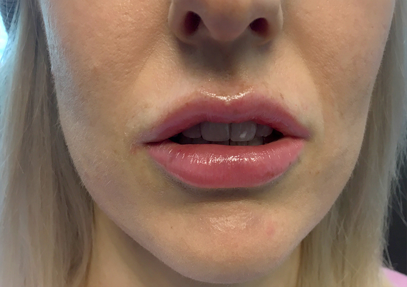 Injectables And Fillers 126