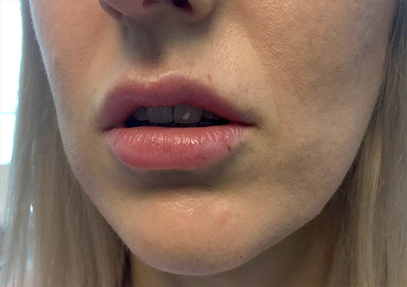 Injectables And Fillers 05