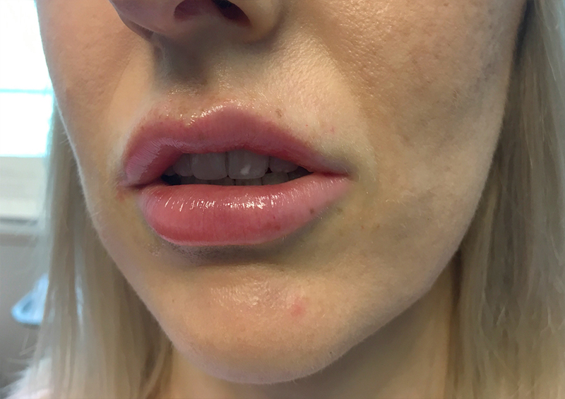 Injectables And Fillers 05