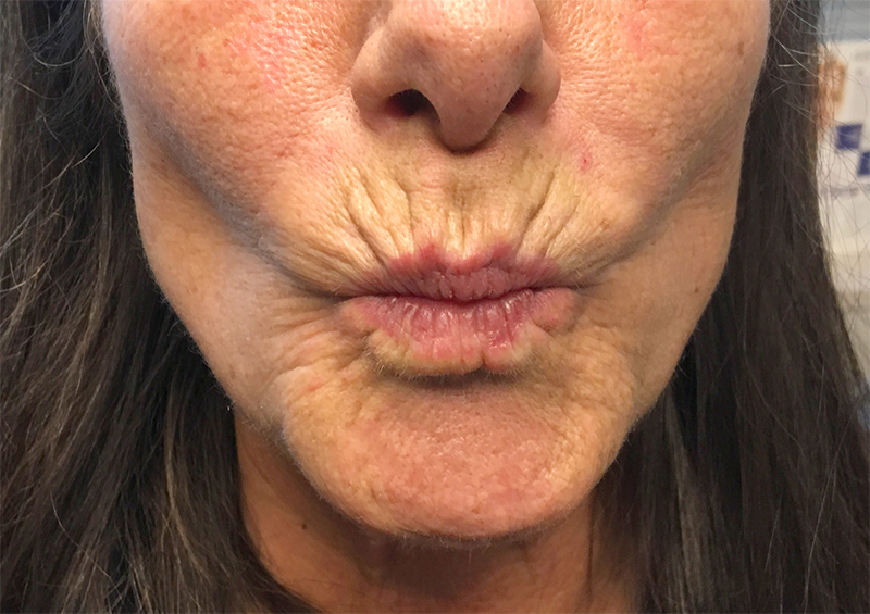 Injectables And Fillers 01