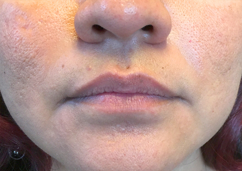 Injectables And Fillers 01