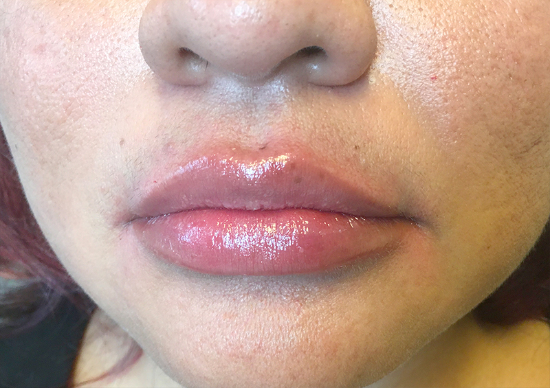 Injectables And Fillers 128