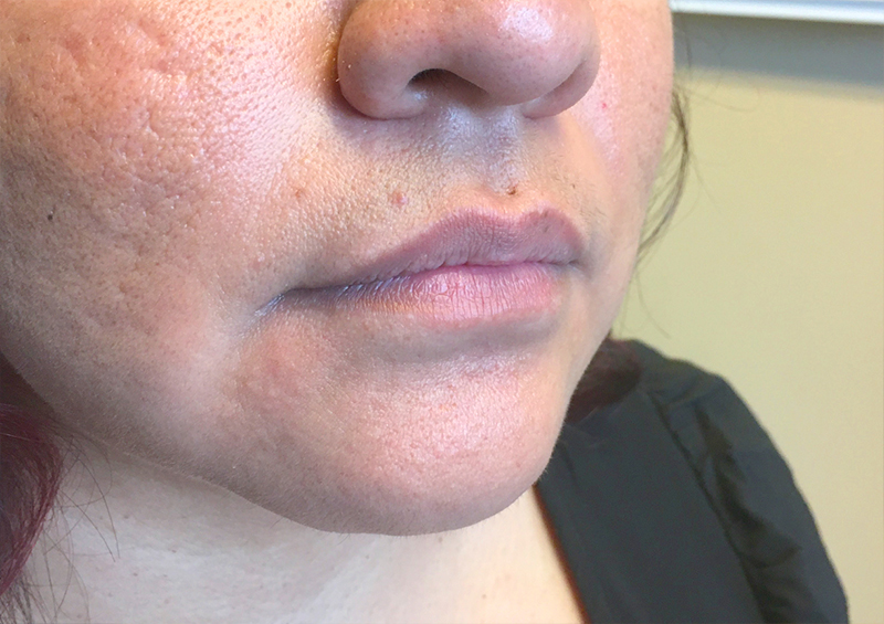 Injectables And Fillers 03