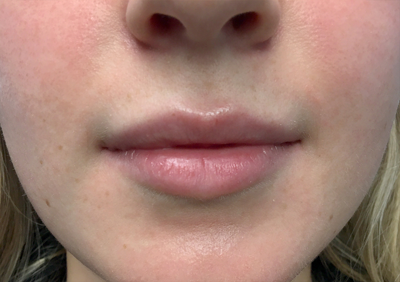 Injectables And Fillers 01