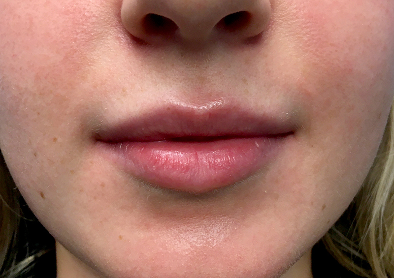 Injectables And Fillers 129