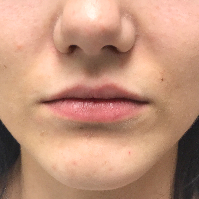 Injectables And Fillers 01