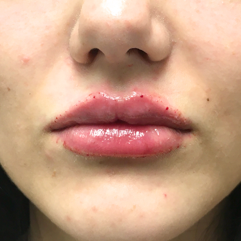 Injectables And Fillers 13