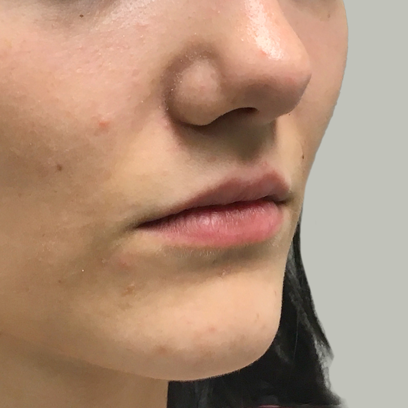 Injectables And Fillers 03