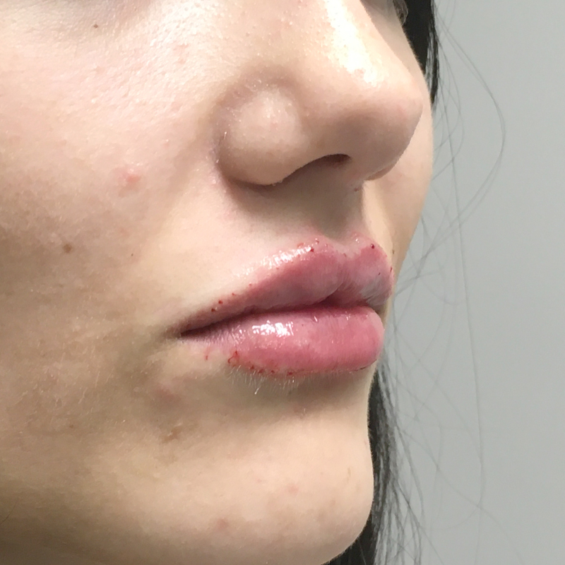 Injectables And Fillers 03