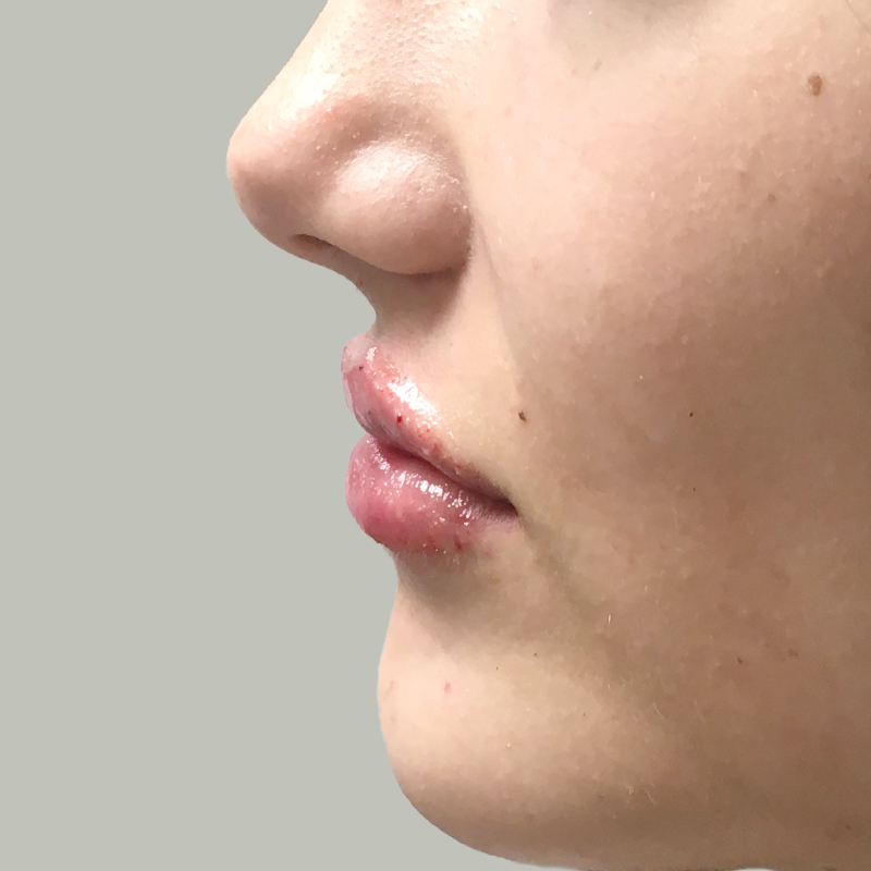 Injectables And Fillers 05