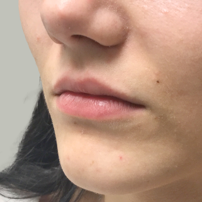 Injectables And Fillers 07